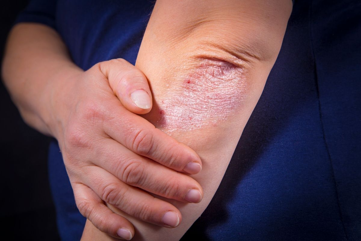 Psoriasis is a autoimmune condition that causes the skin to rapidly overproduce resulting in a buildup that resembles scaly patches on the body. Here's how medical CBD can help.