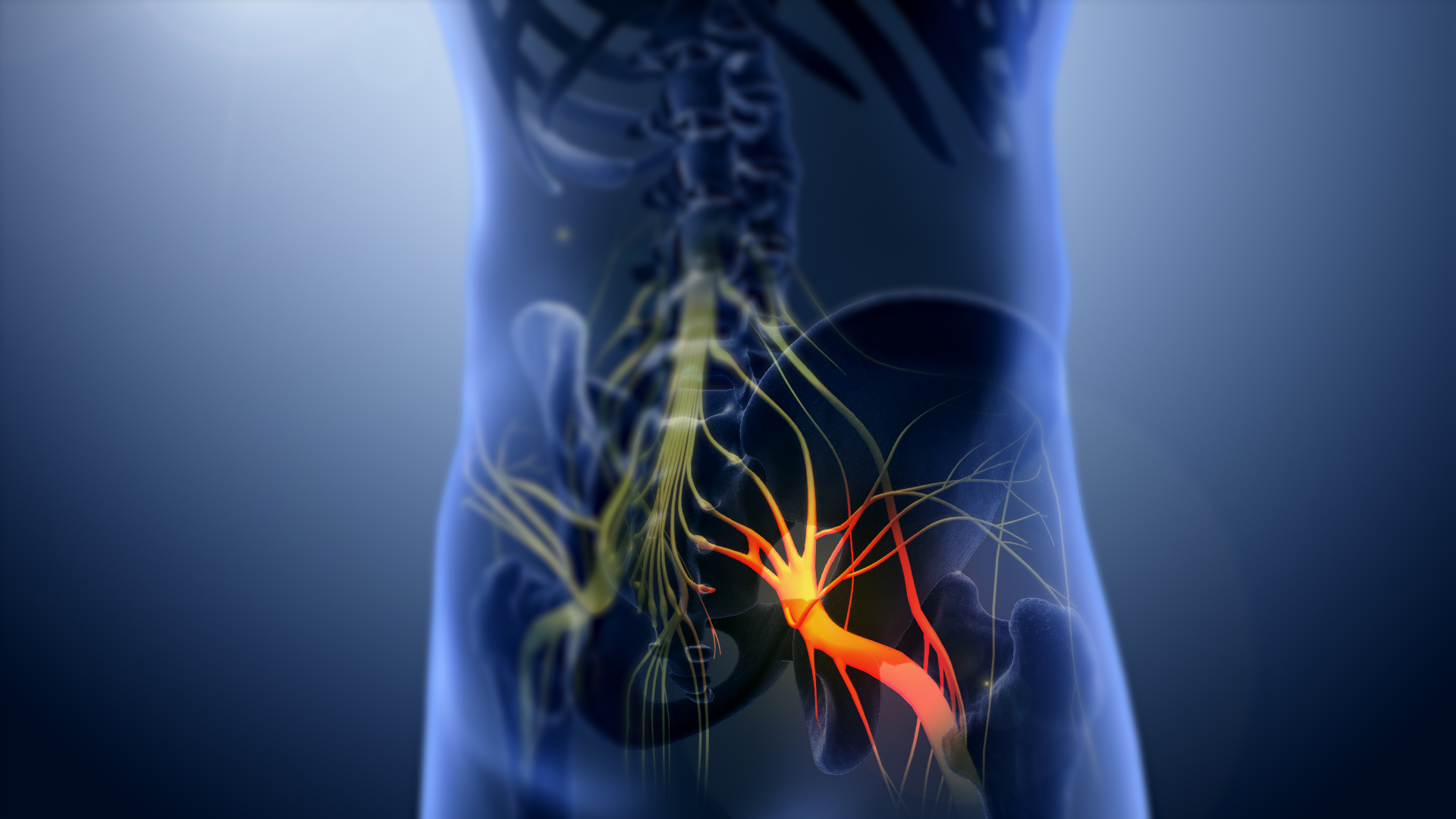 Sciatica pain is caused by a problem with the sciatica nerve. This pain can progress to the hips, legs and buttocks